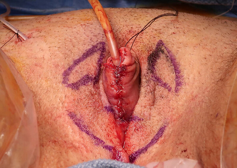 Metoidioplasty using labial advancement flaps for urethroplasty