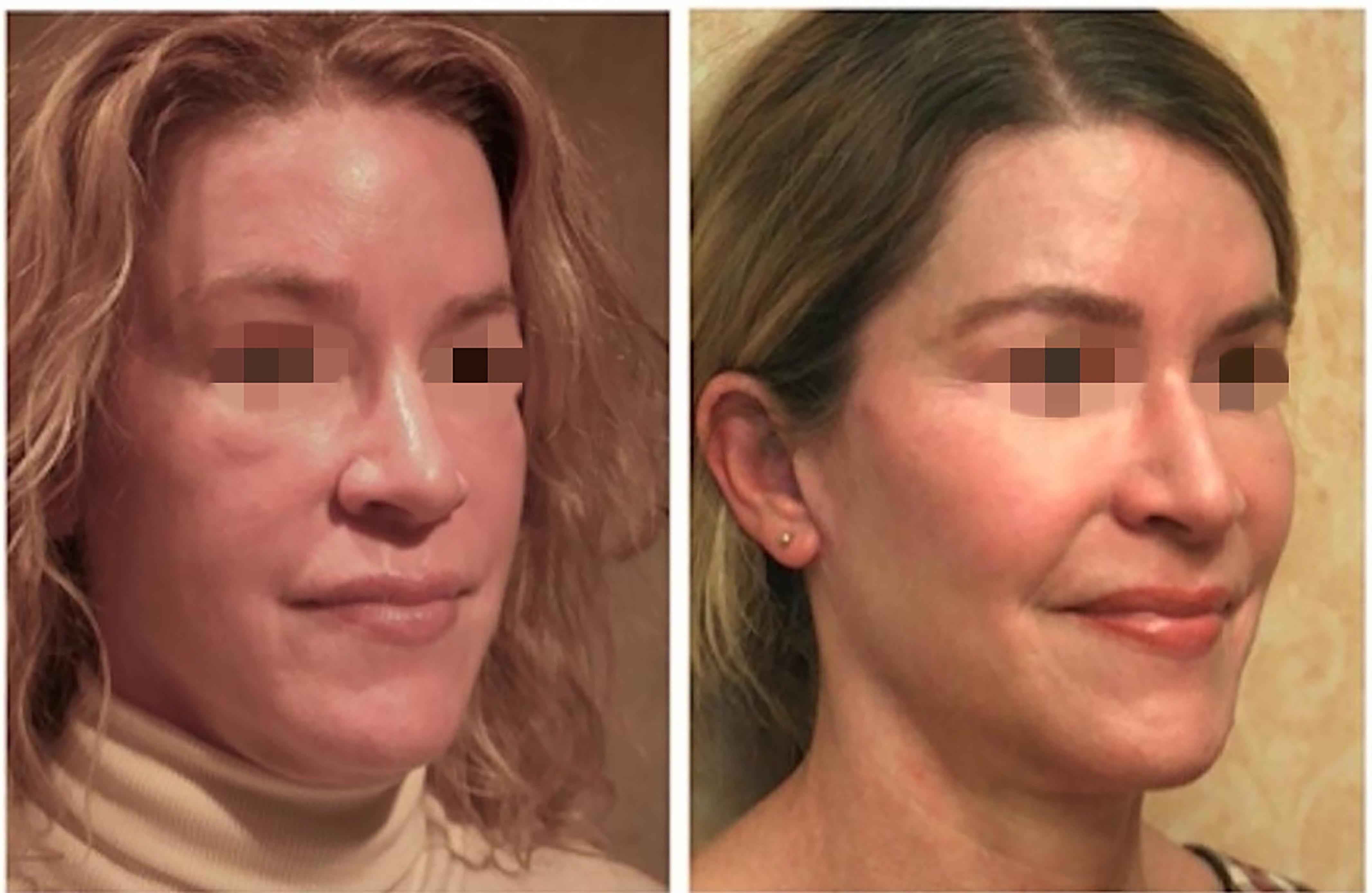 Complications of facial autologous fat grafting