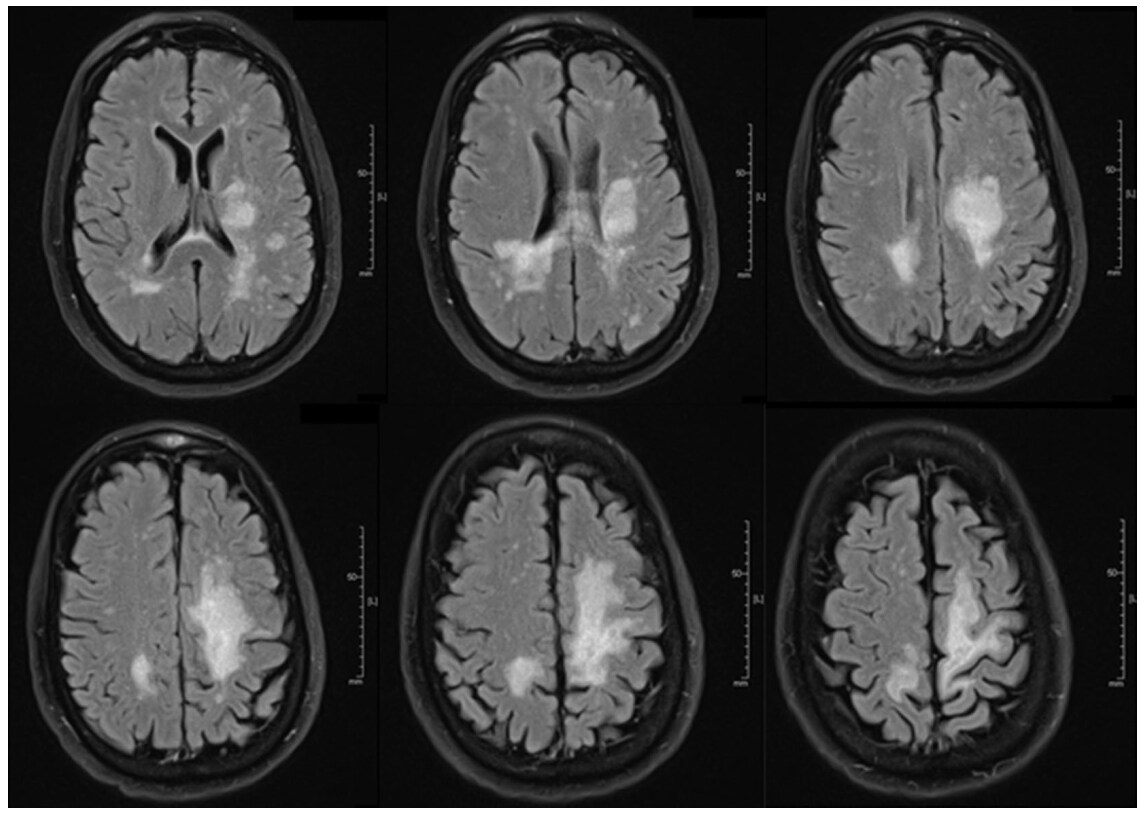 Progressive multifocal leukoencephalitis in a patient with sarcoidosis on hydroxychloroquine with negative cerebrospinal fluid testing for the John Cunningham virus