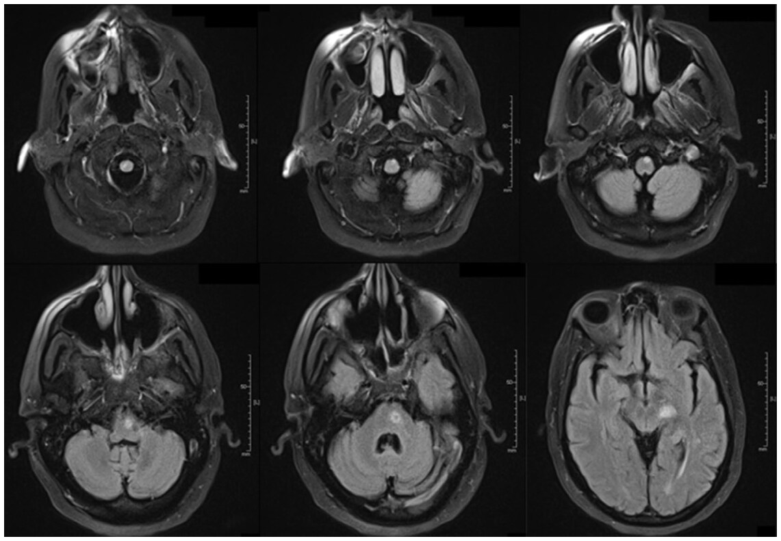 Progressive multifocal leukoencephalitis in a patient with sarcoidosis on hydroxychloroquine with negative cerebrospinal fluid testing for the John Cunningham virus