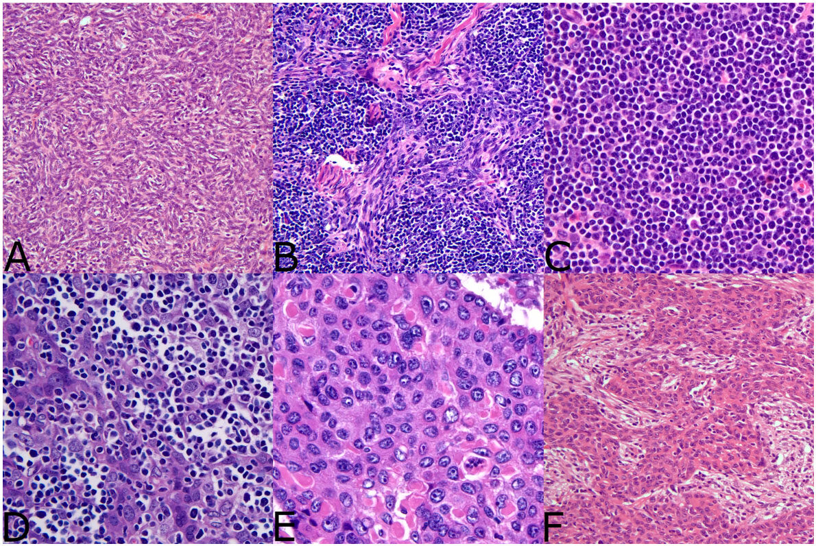 Molecular pathology of thymoma and thymic carcinoma